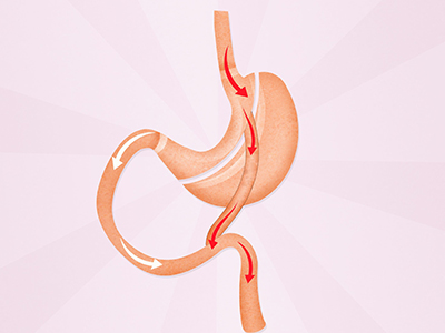 Laparoscopic Single Anastomosis Gastric Bypass