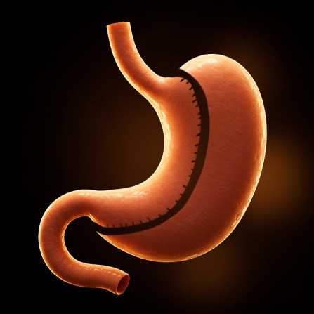 Laparoscopic Gastric Sleeve