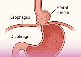 Laparoscopic Hiatal Hernia Repair